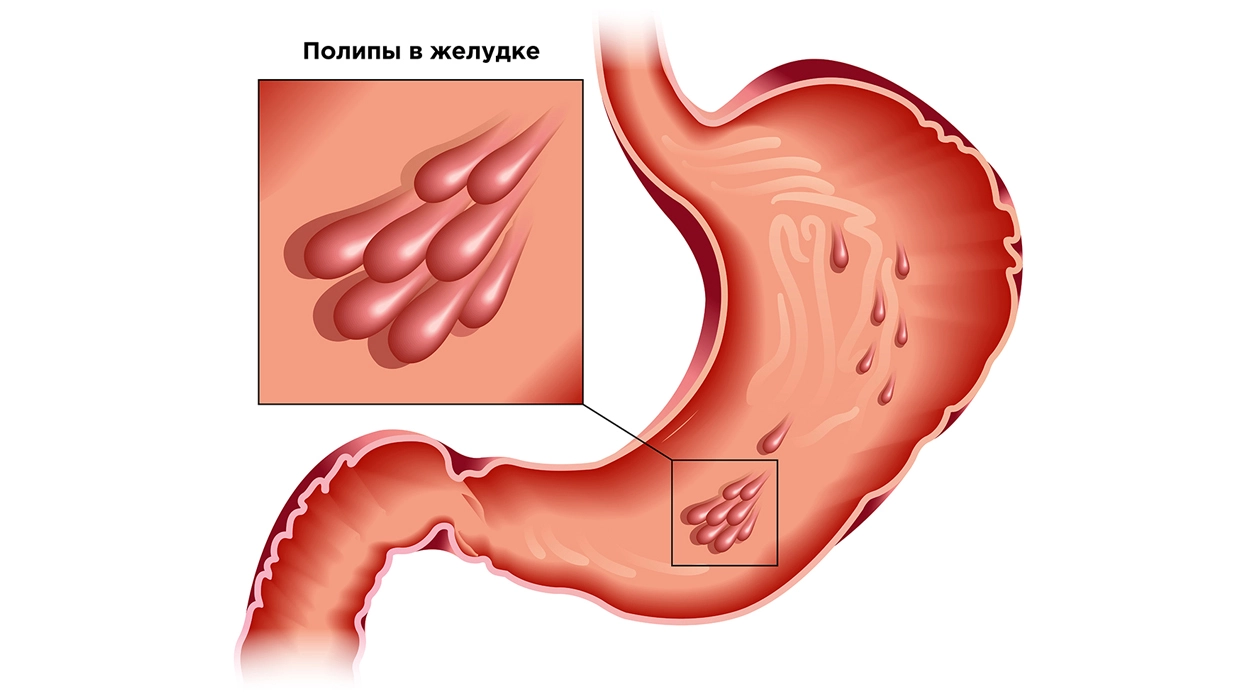 Полипы прямой кишки: симптомы и лечение в сети клиник НИАРМЕДИК